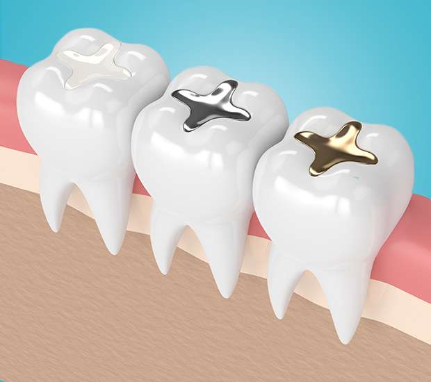 Costa Mesa Composite Fillings